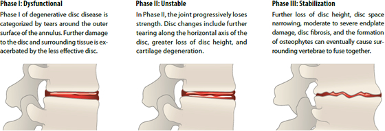 degenerative disc disease solution