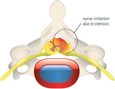 foraminal stenosis