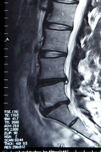 herniated discs